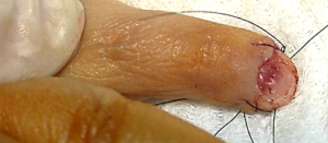 amputacion distal dedo 1