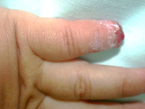 amputacion distal dedo
