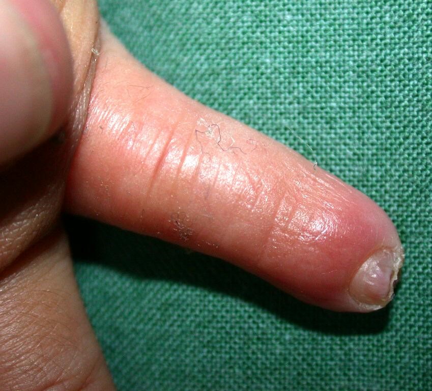 amputacion distal dedo 2
