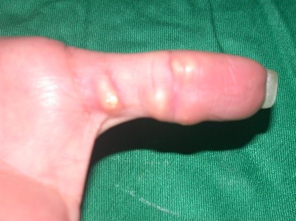 calcinosis