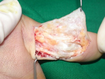 calcinosis1