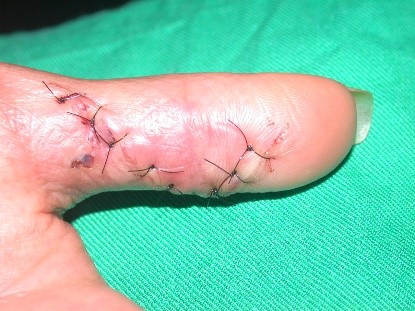 calcinosis2