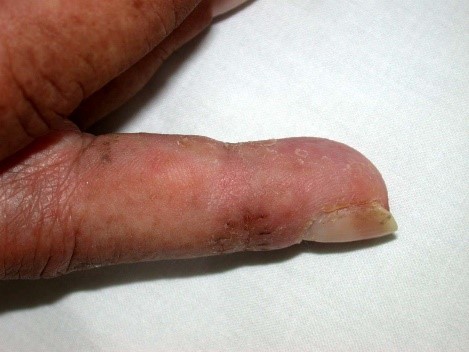 dedo en martillo postraumatico 2