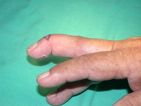 dedo en martillo postraumatico
