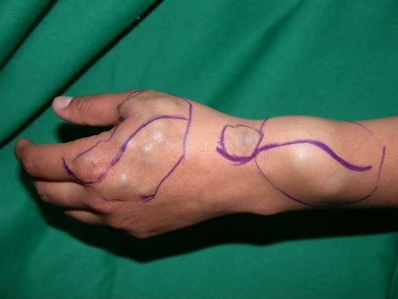 hemangioma 1