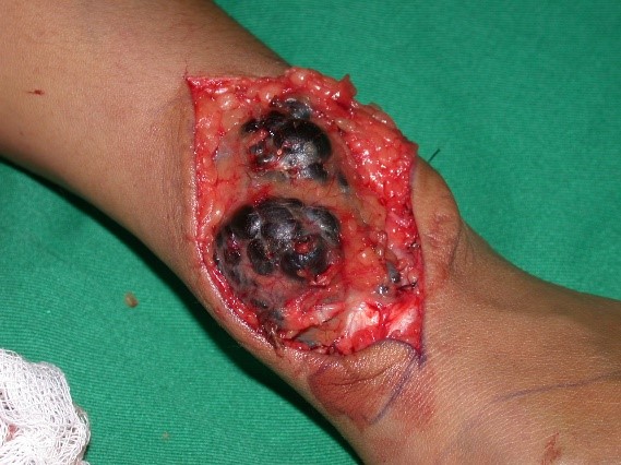 hemangioma 2