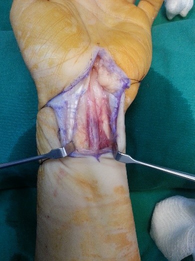 hematoma intraneural nervio mediano 1