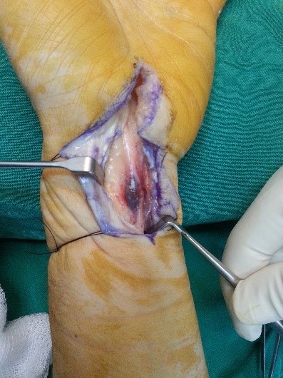 hematoma intraneural nervio mediano