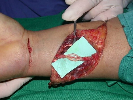 injertos nerviosos en nervio cubital