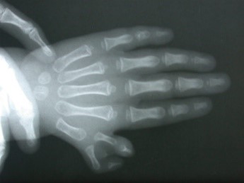 polidactilia pulgar derecha