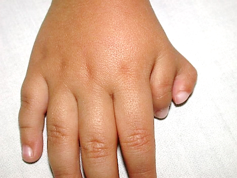 polidactilia pulgar mano derecha