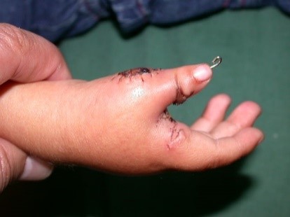 polidactilia pulgar mano derecha1
