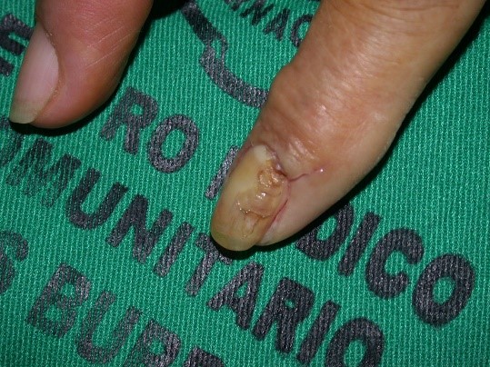 quiste sinovial1