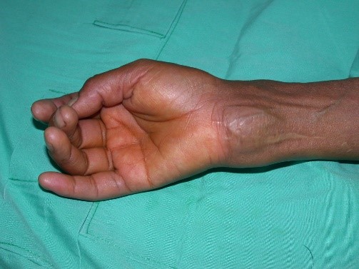tumor sinovial de muneca
