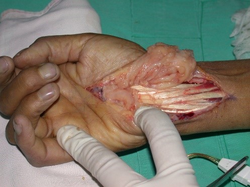 tumor sinovial de muneca1